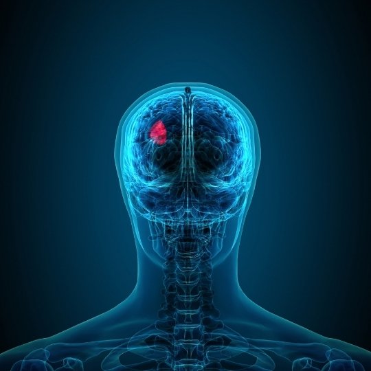 TUMORES CEREBRALES REVISTA MARKETING
