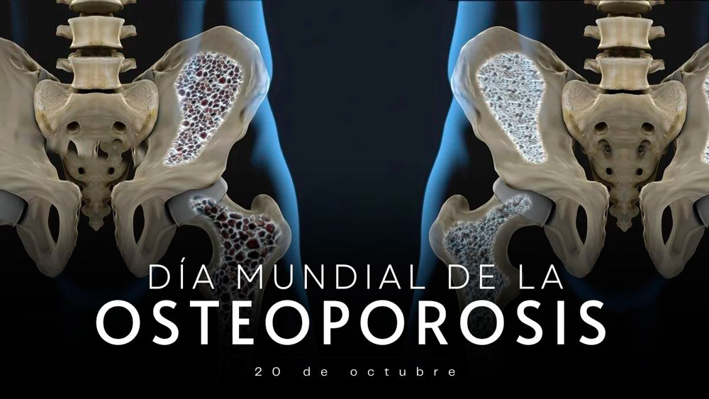 Día Mundial de la Osteoporosis