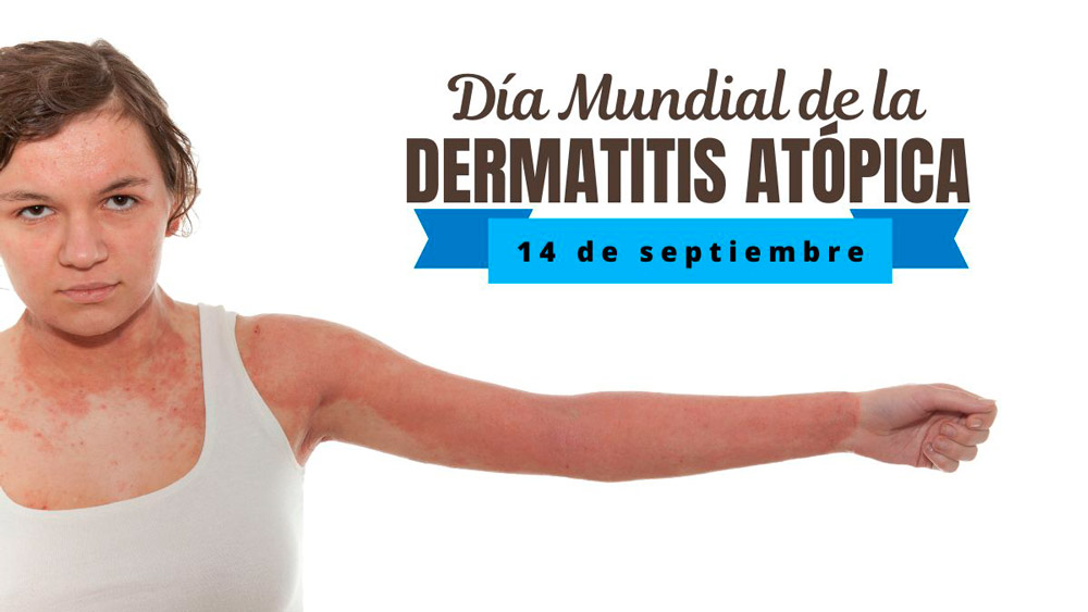 Día Mundial de la Dermatitis Atópica